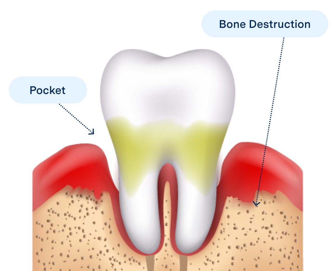 Illustration of periodontitis showing gum pockets and bone destruction around a tooth, representing advanced gum disease for Aspen Dental.
