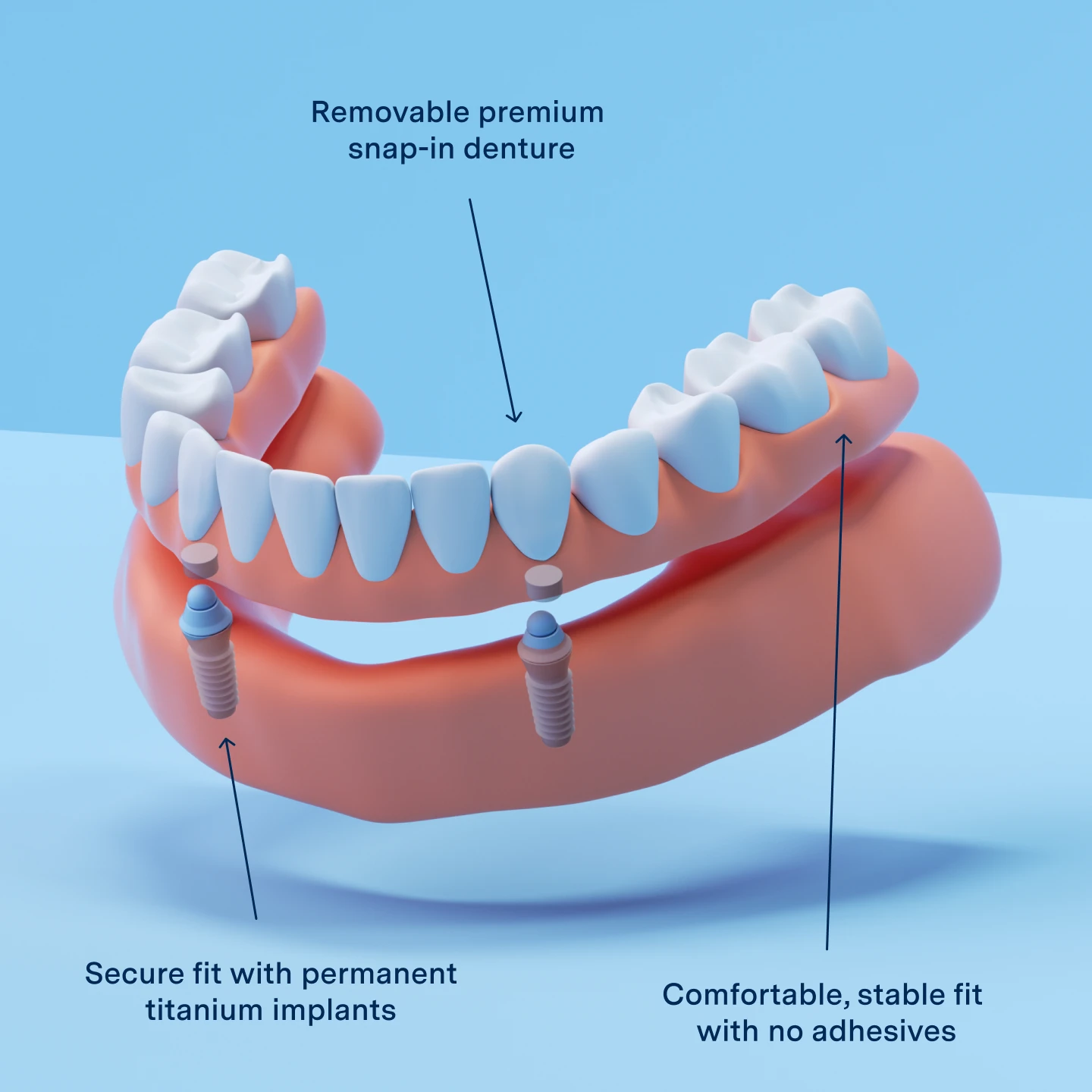 Graphic of Implant dentures, showing the features which include removeable premium snap-in denture, with the secure fit of permanent titanium implants, designed for a comfortable, stable fit with no adhesives.