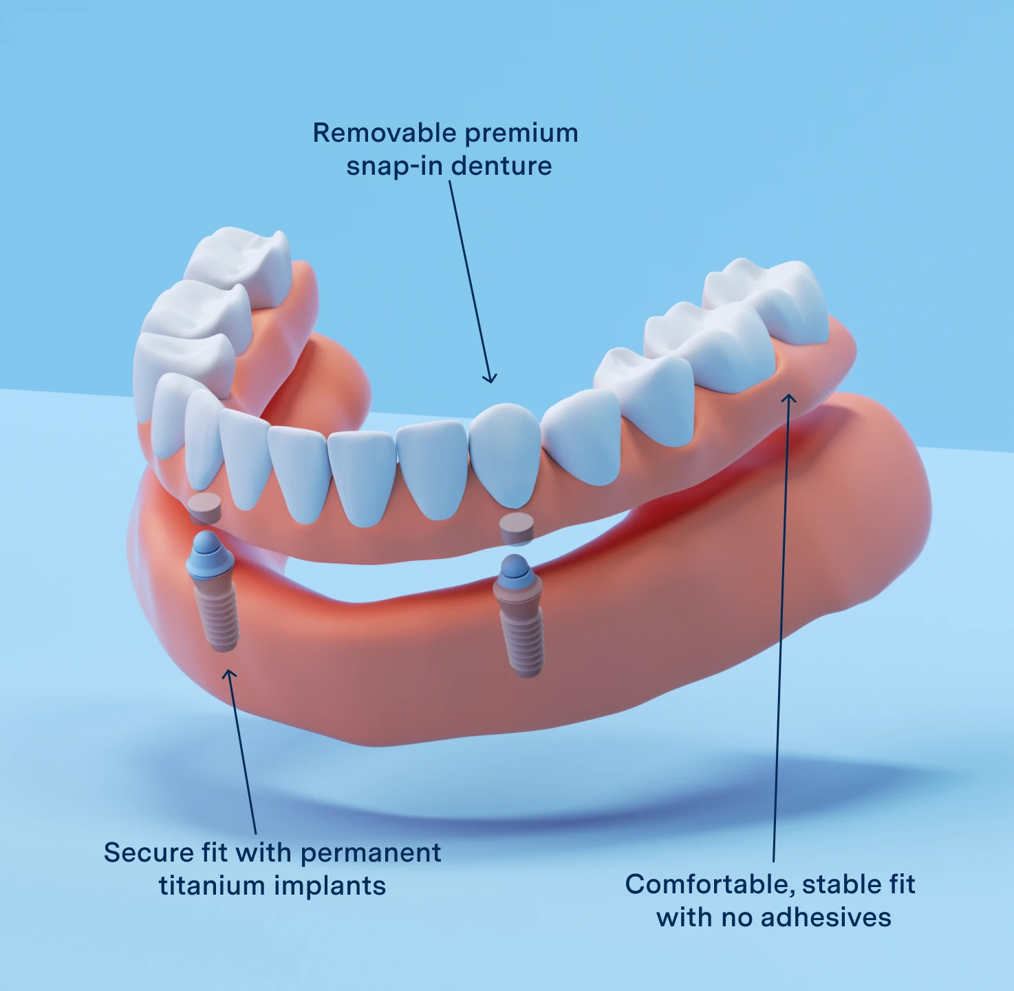 Graphic of Implant dentures, showing the features which include removeable premium snap-in denture, with the secure fit of permanent titanium implants, designed for a comfortable, stable fit with no adhesives.