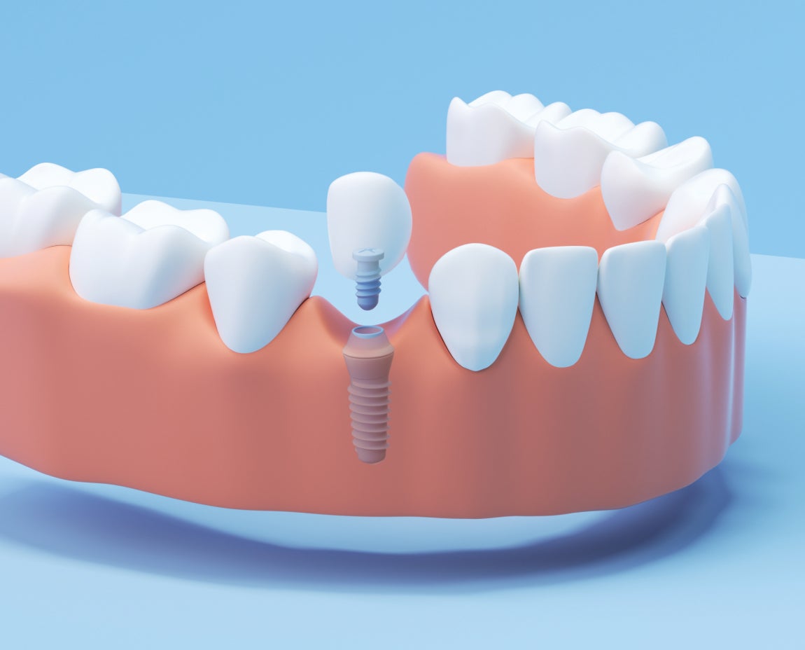 Illustration of a Single Tooth Implant being inserted into the lower jaw, showing the gum, surrounding teeth, and the implant screw with a crown positioned above it.