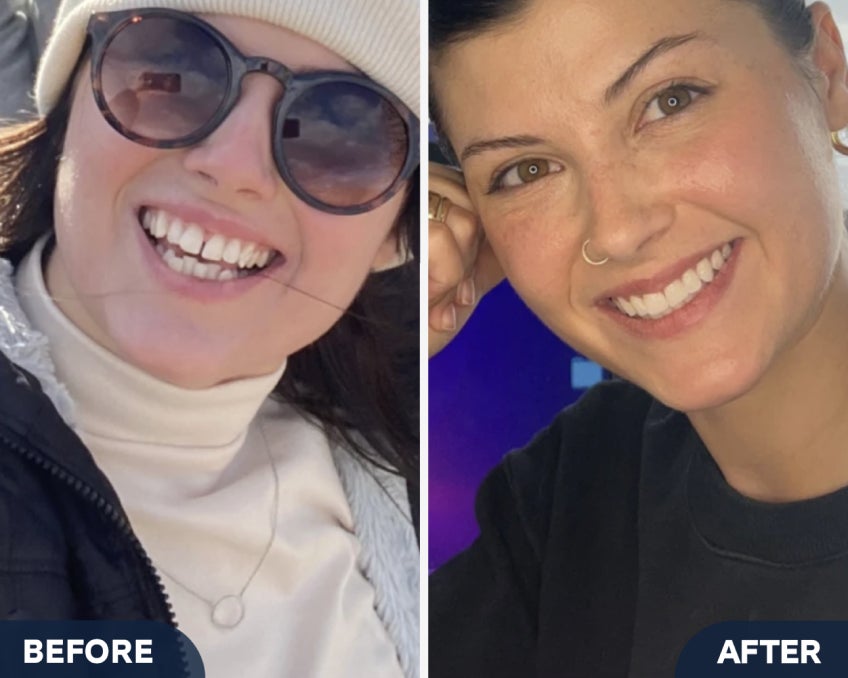 Before and after images of a woman named Supriya B. from Chicago, IL, highlighting her smile transformation with Motto clear aligners. The before image shows her smiling in sunglasses and winter attire, while the after image displays a more aligned smile. A testimonial below reads, “My doctor got me a perfect smile faster in almost half the time that my last Ortho had me on track for.”