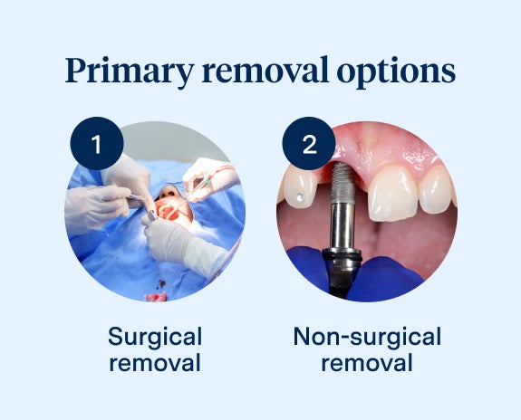 Illustration from Aspen Dental showing primary removal options for dental implants, including surgical removal and non-surgical removal methods.