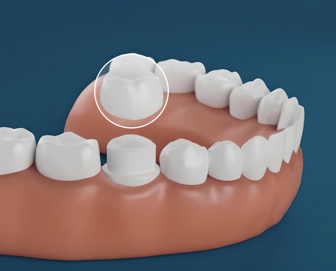 A dental crown being placed on a tooth model, demonstrating dental crown procedure.