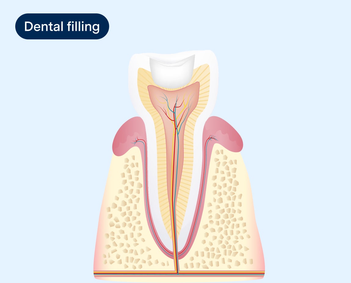 Cross-section diagram of a tooth with a dental filling, showing the inner structure of the tooth, including the nerves and enamel, with a filling placed at the top to restore the tooth.