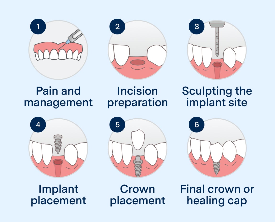 A step-by-step diagram illustrating the dental implant surgery process, including pain management, incision preparation, implant site sculpting, implant placement, crown placement, and final crown or healing cap.