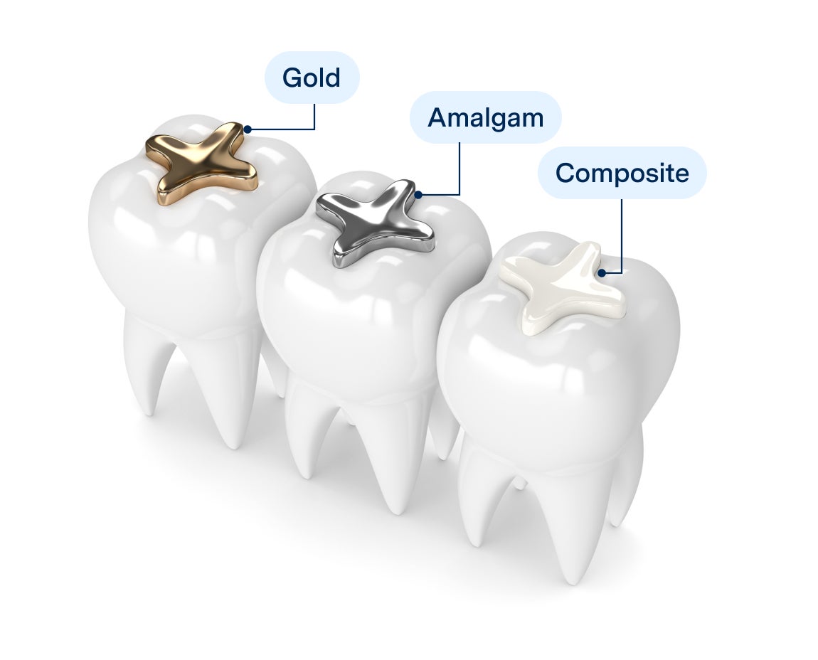 Three teeth with different types of fillings: gold, amalgam, and composite. Labels indicate each filling type above the corresponding tooth.