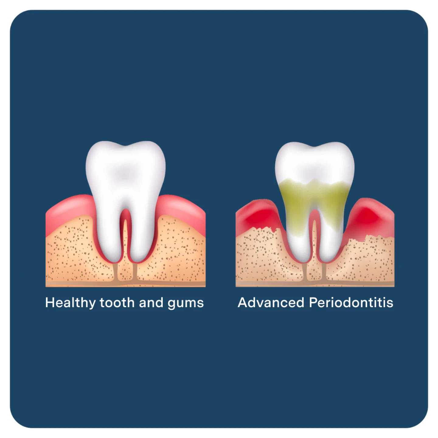 Comparison of healthy tooth and gums with advanced periodontitis. Healthy: pink gums, white tooth. Diseased: red, swollen gums, tooth decay.