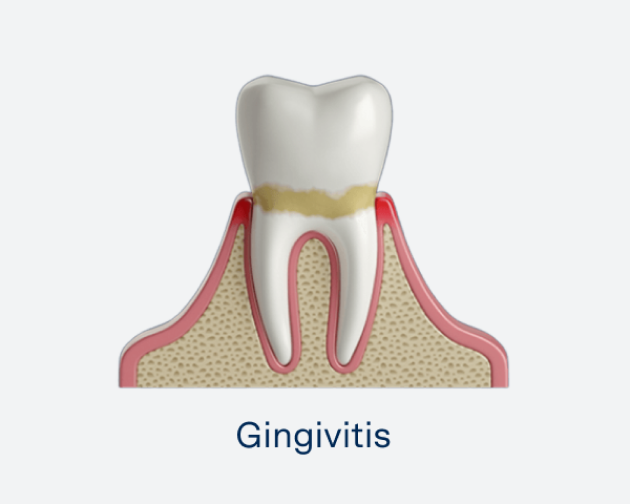  Illustration showcasing a tooth with inflamed gums, displaying a condition known as gingivitis.