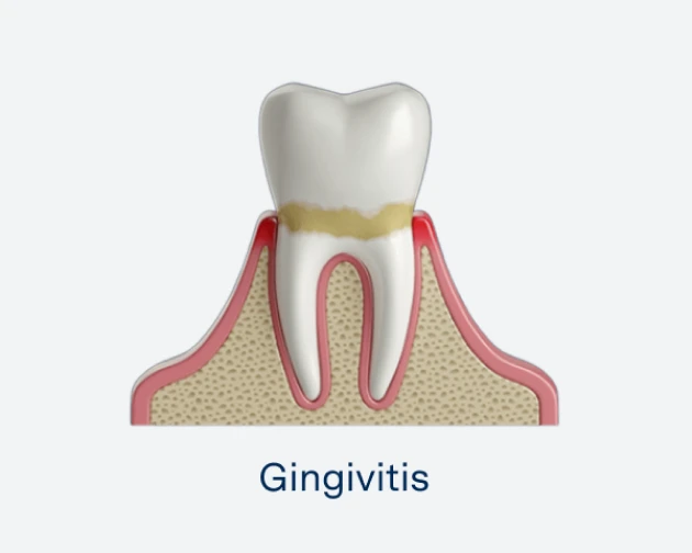 Illustration showcasing a tooth with inflamed gums, displaying a condition known as gingivitis.