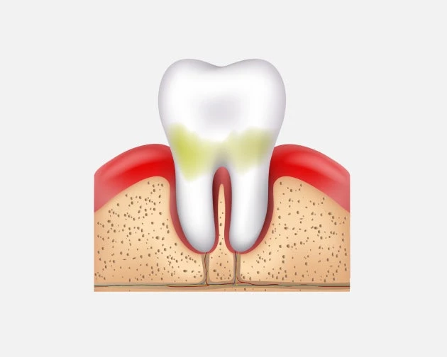 An image of tooth and gums infected with gingivitis.
