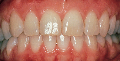 Aspen Dental Healthy gums Image