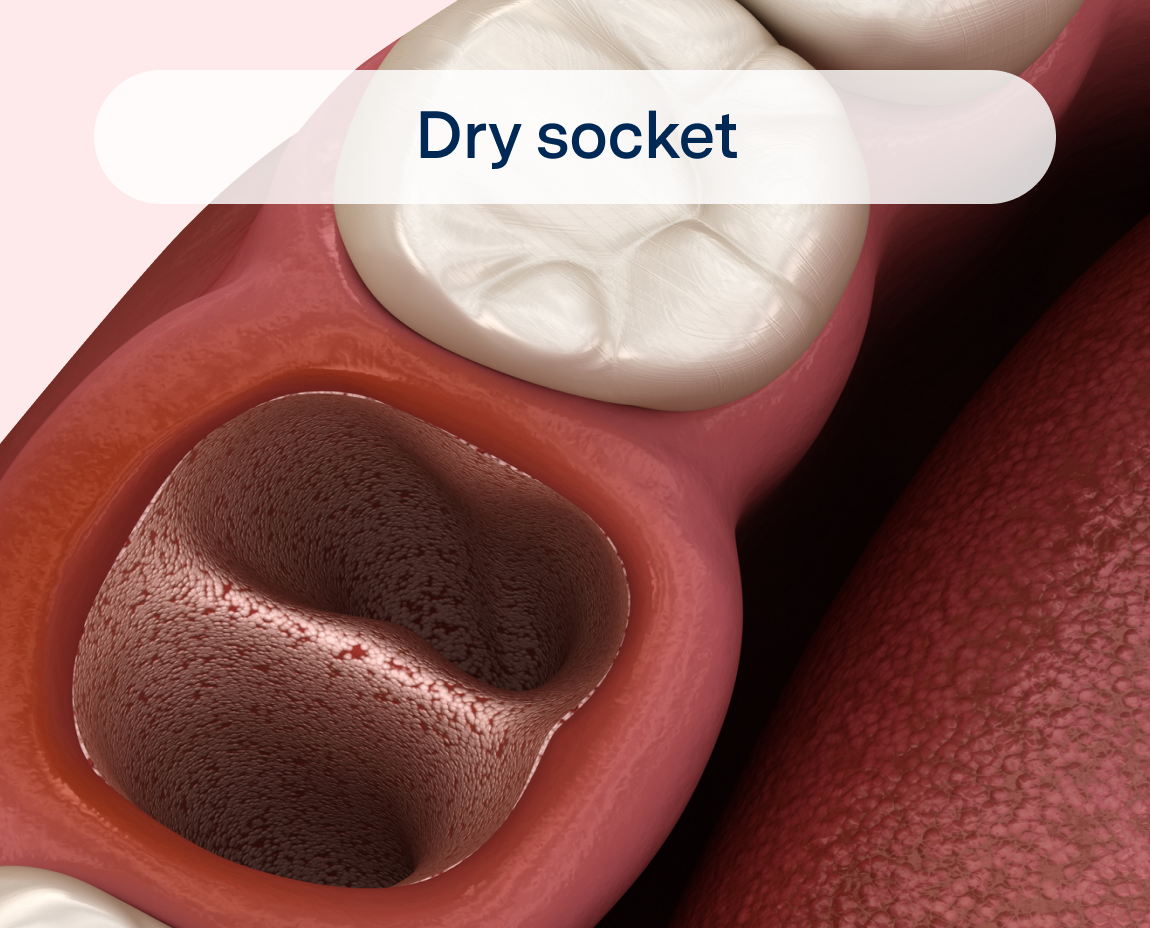 A graphic of a dry socket, a condition that may occur after wisdom teeth extraction.