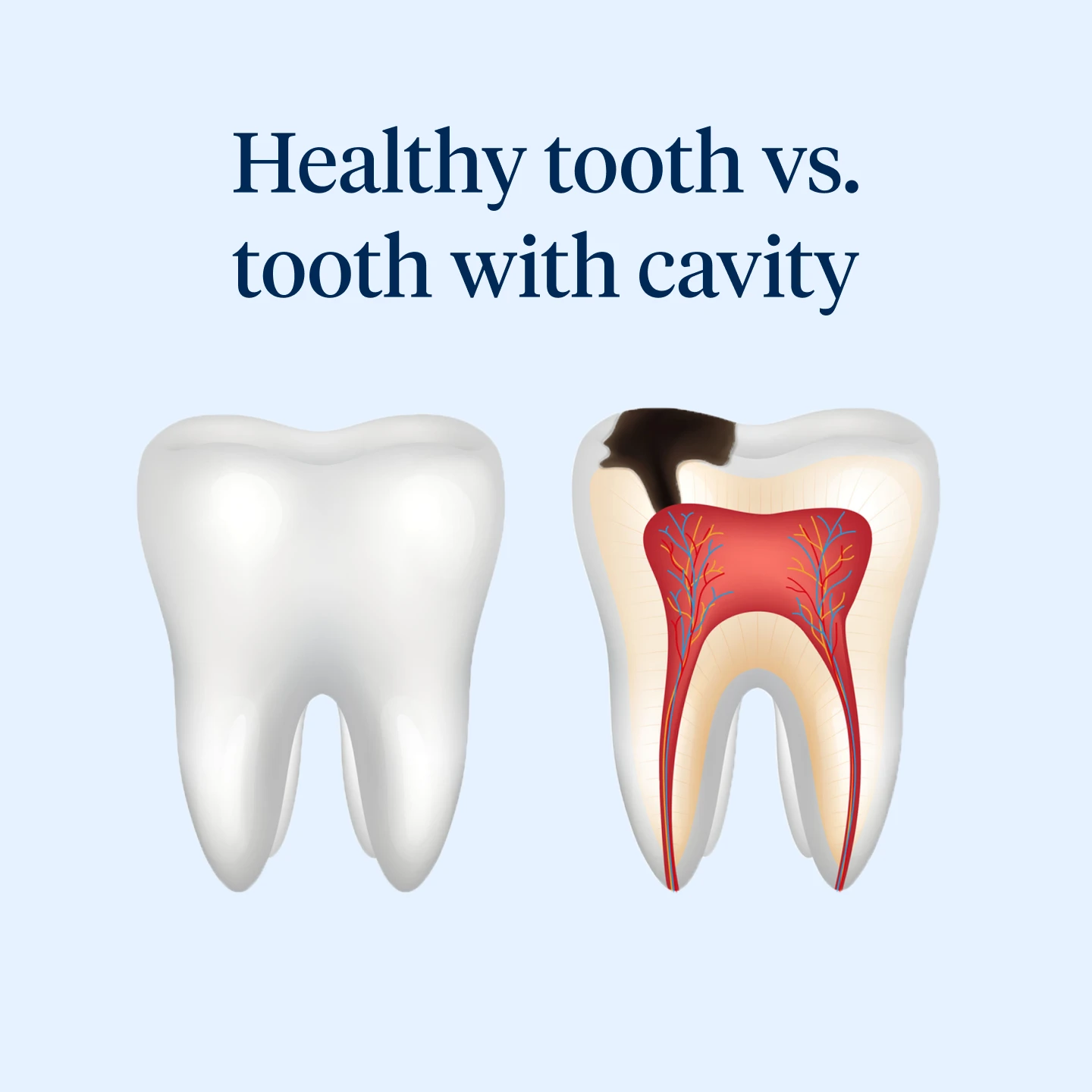 Healthy tooth vs tooth with cavity. 