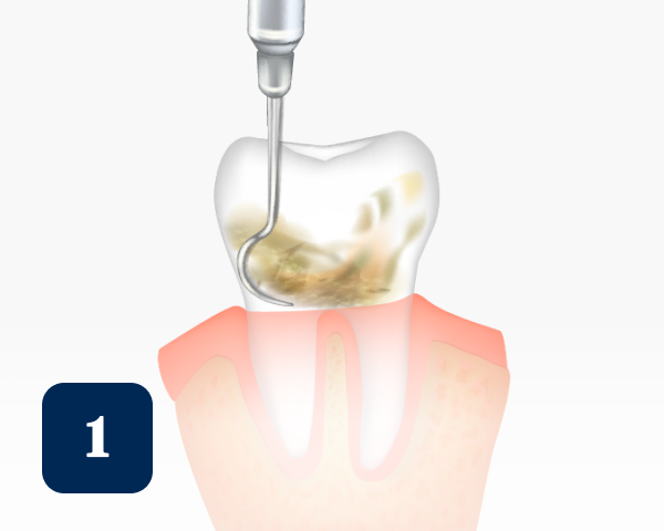 Illustration showing a dental scaler in use, cleaning plaque and tartar buildup on a tooth. Gums are shown in pink, and a blue square with the number 1 is in the bottom left corner.