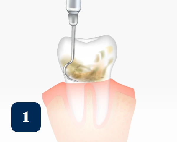 Illustration showing a dental scaler in use, cleaning plaque and tartar buildup on a tooth. Gums are shown in pink, and a blue square with the number 1 is in the bottom left corner.