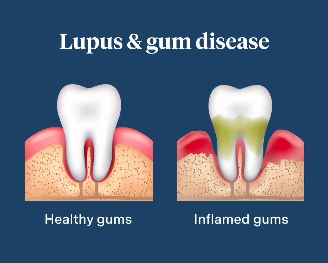 Illustration comparing healthy gums with inflamed gums related to lupus and gum disease. The graphic showing a healthy tooth with pink gums on the left and a tooth with gum inflammation and discoloration on the right against a navy blue background, with text labels "Healthy gums" and "Inflamed gums".