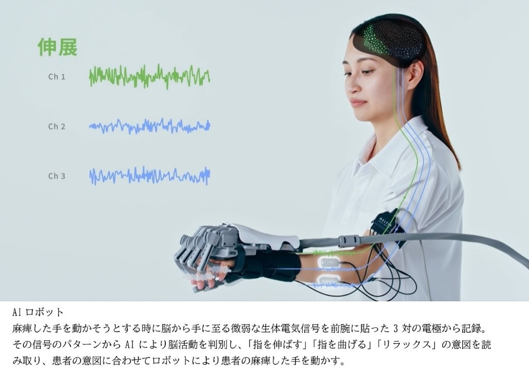 世界初、AIロボットによるリハビリで脳卒中後の麻痺手の機能改善─順天堂大ら