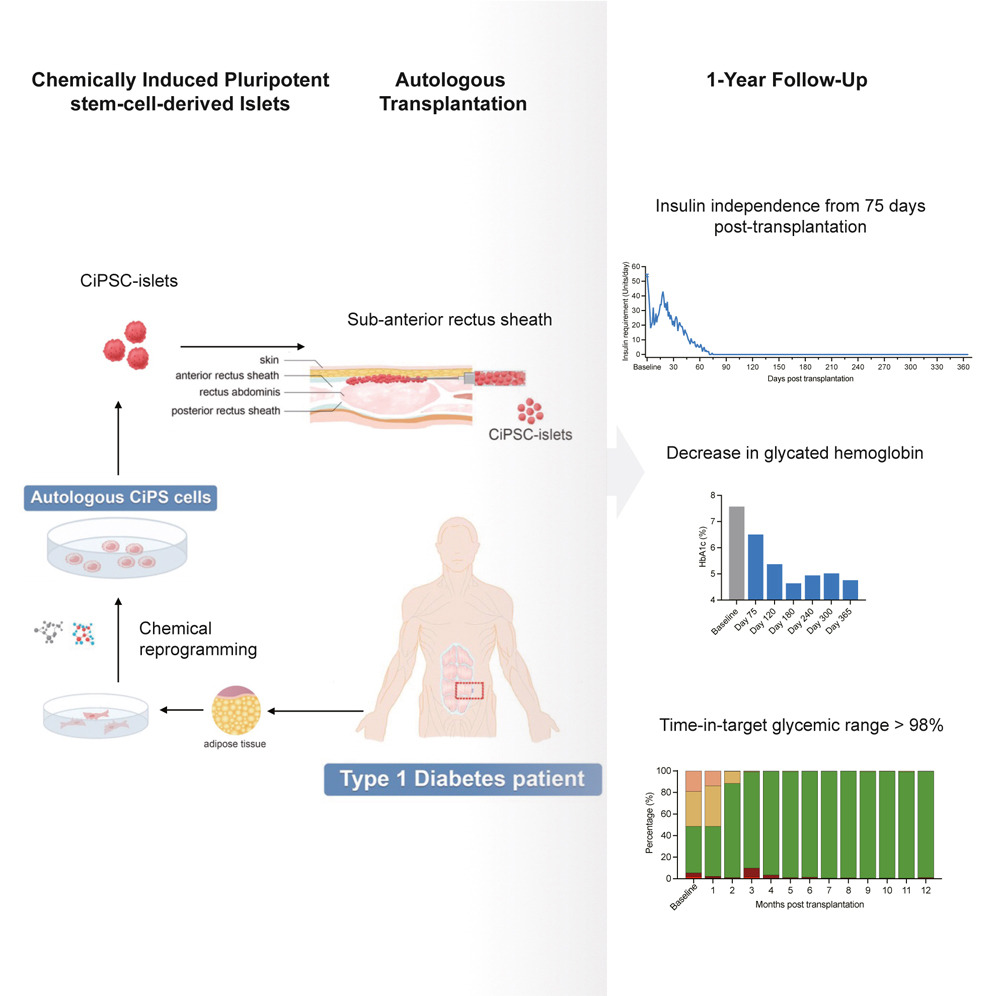 中国の研究チーム、1型糖尿病患者が自身の細胞から膵島を生成し、75日後にインスリン不要を達成
