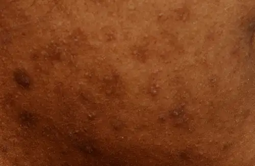 Dark Spots