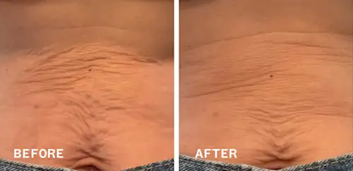 Before & After Stomach
