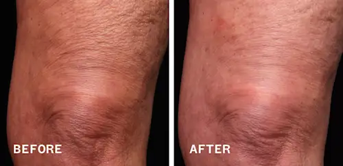 Before & After Legs