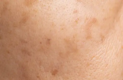 Sun Damage