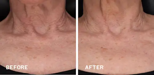 Before & After Chest Result