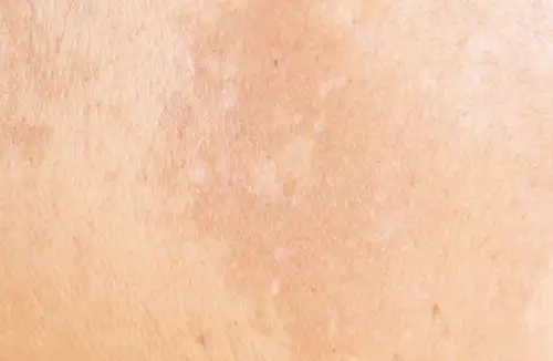 Malasma