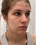 Lauren - Before