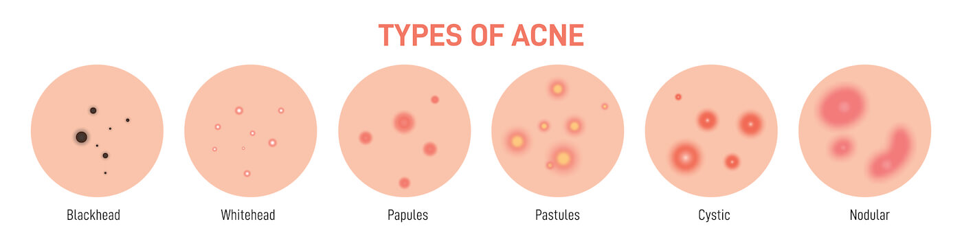types-of-acne