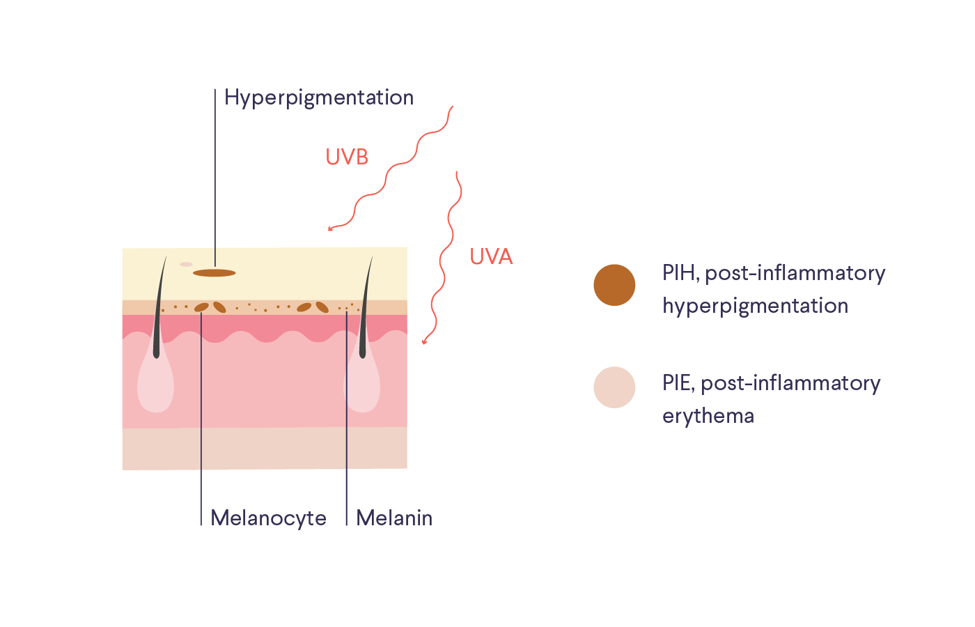 Illustration / diagram of skin with labels "Hyperpigmentation," "Melanocyte," "Melanin," "UVB," "UVA," and a key: "PIH, post-inflammatory hyperpigmentation" and "PIE, post-inflammatory erythema"