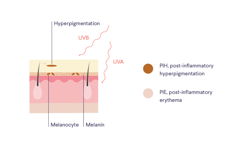 Illustration / diagram of skin with labels "Hyperpigmentation," "Melanocyte," "Melanin," "UVB," "UVA," and a key: "PIH, post-inflammatory hyperpigmentation" and "PIE, post-inflammatory erythema"