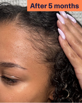 Natani after 5 months hair growth