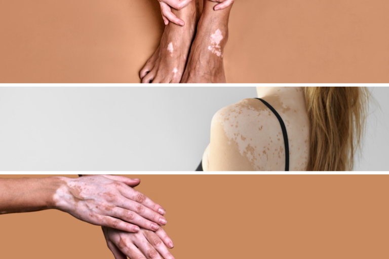 vitiligo disease effects