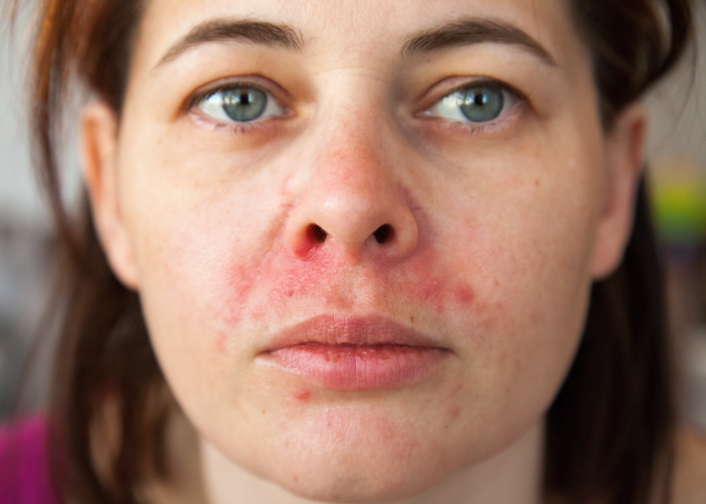 Face perioral dermatitis - Everything you need to know about irritated skin
