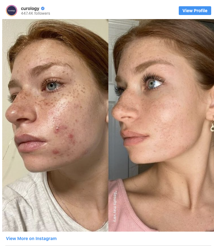 Instagram screenshot from Curology. Before and after photo