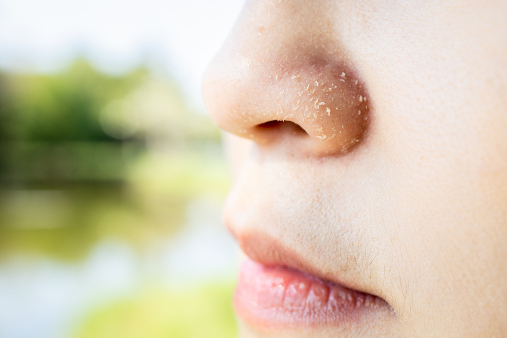 Close up to woman's nose with dry, flaky and peeling nose