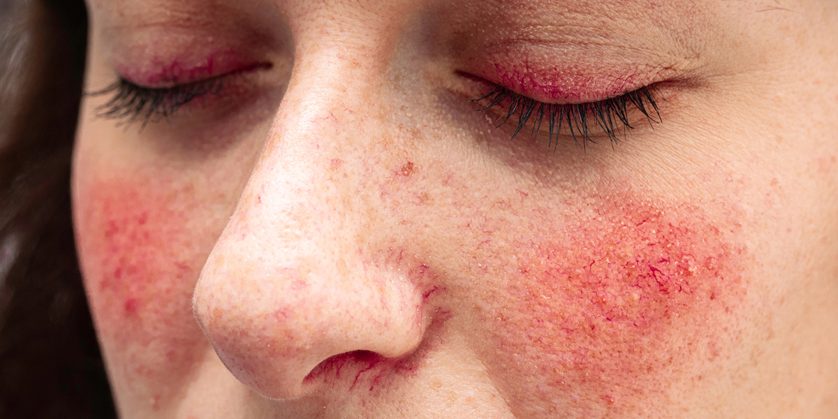 Rosacea skin redness on cheeks