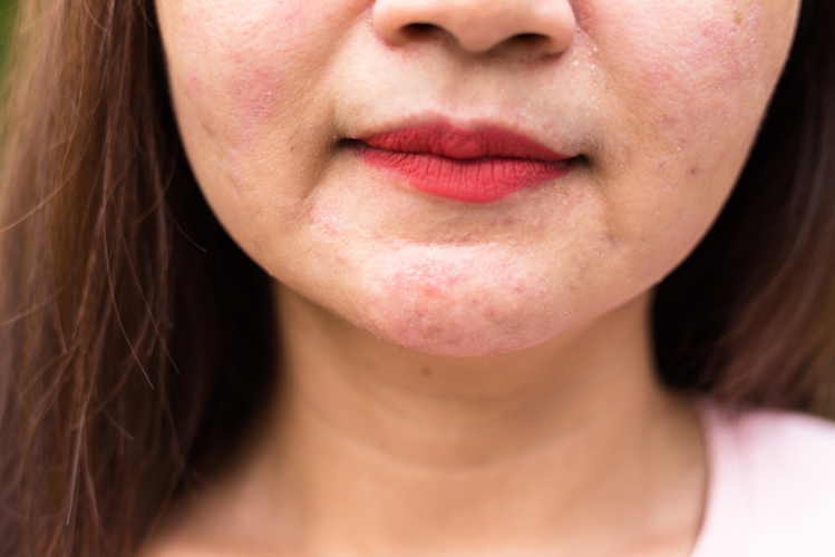 Have a rash on one side of your face? Here's how to treat it