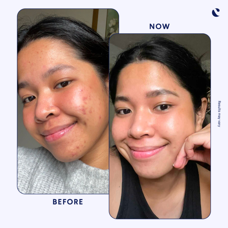Hyperpigmentation before and after treatment 
