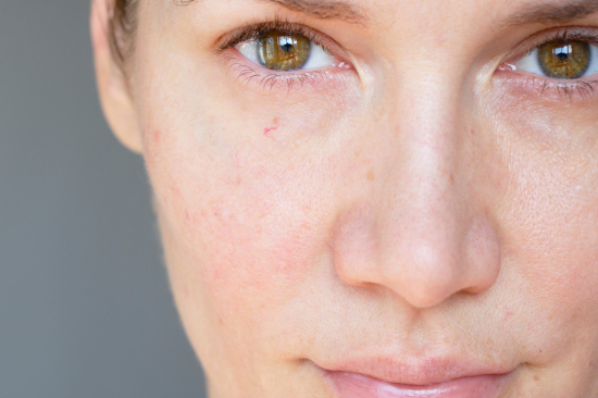woman-with-sensitive-skin-cropped-portrait