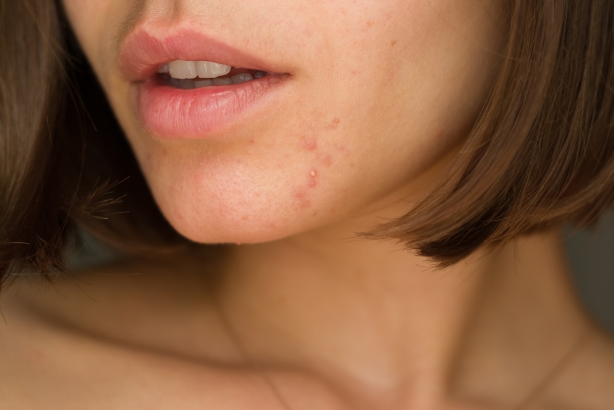 Young girl with acne on chin