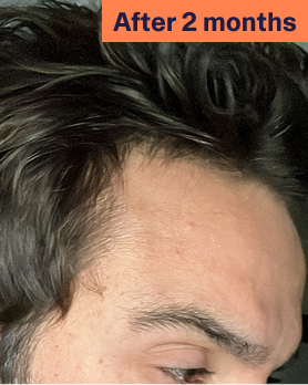 Jordan After Hair Loss