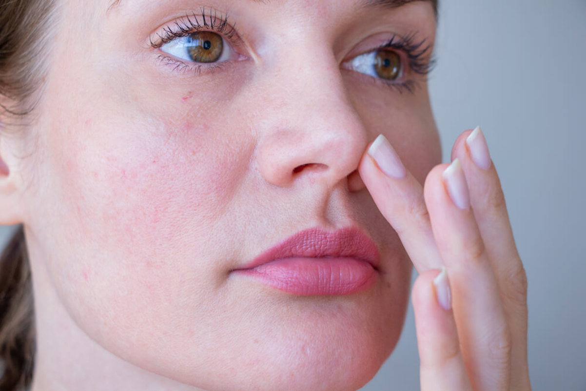 Woman with Mild Rosacea