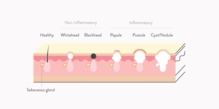 Illustration of pores with text "Non-inflammatory:" Healthy," "Whitehead," "Blackhead," and "Inflammatory:" "Papule," "Pustule," "Cyst/Nodule"