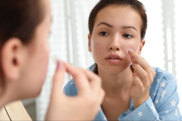 Teen Girl Applying Pimple Patch