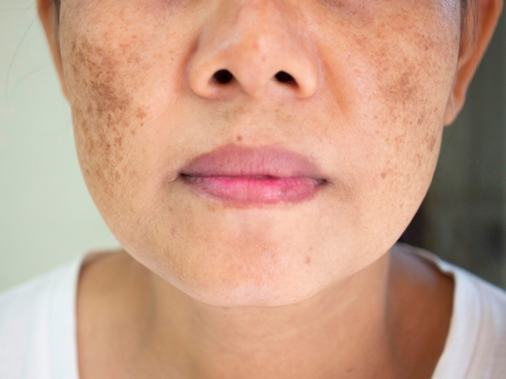 Problem of dark spots on the face of woman
