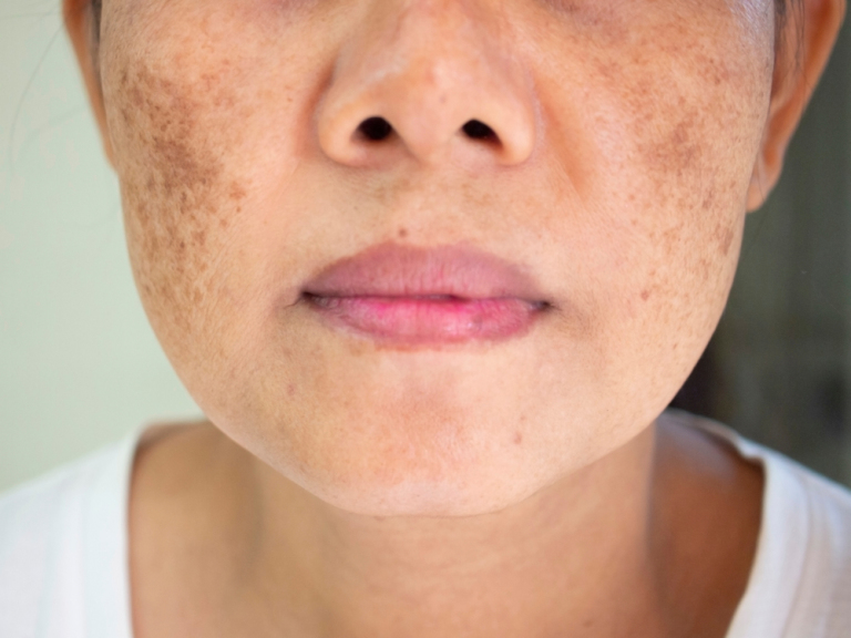 Problem of dark spots on the face of woman