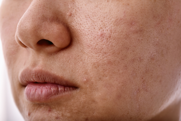 acne-skin-problems