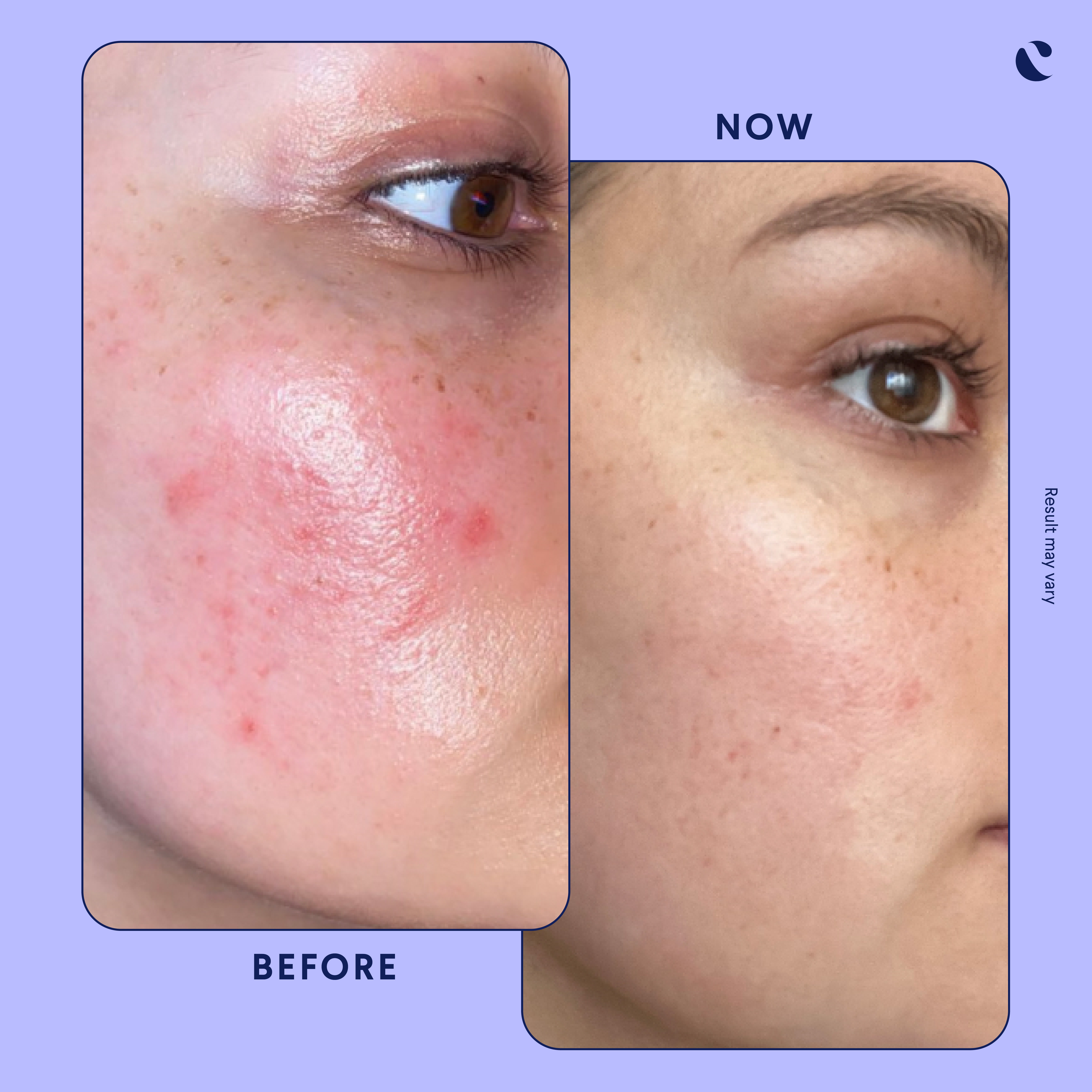 tretinoin before and after aging